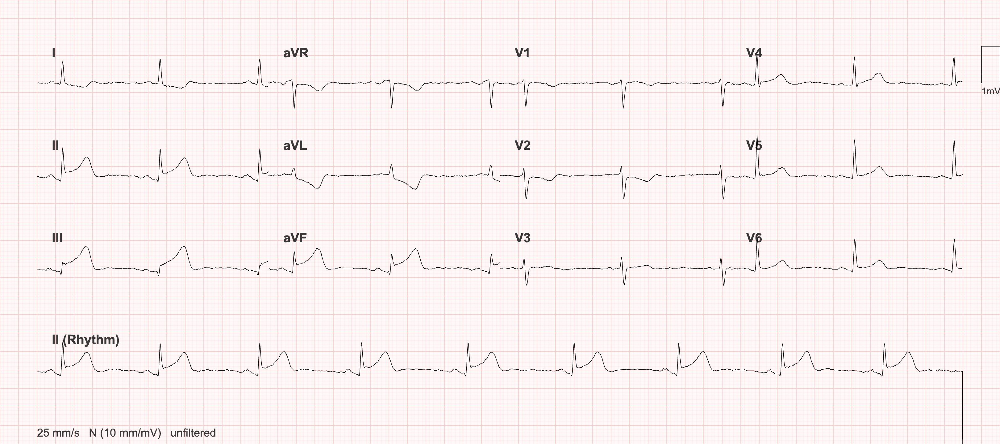 ECG de 12 derivações da paciente da demonstração